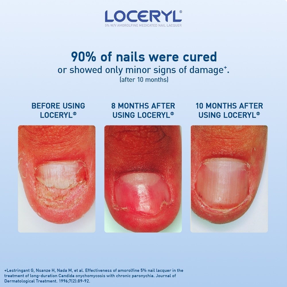 Loceryl Anti-Fungal Nail Treatment (5% W/V Amorolfine Medicated Nail Lacquer) 2.5ml
