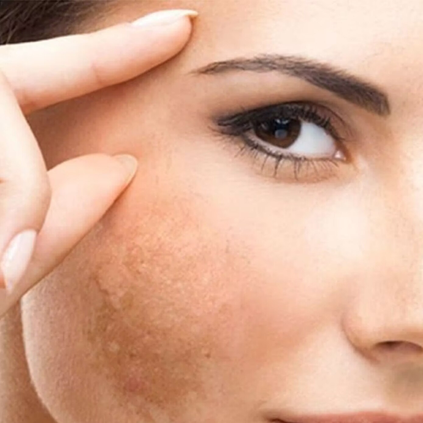 Ferkelan Chelating Hydrogel for Hemosiderin Hyperpigmentation 15ml