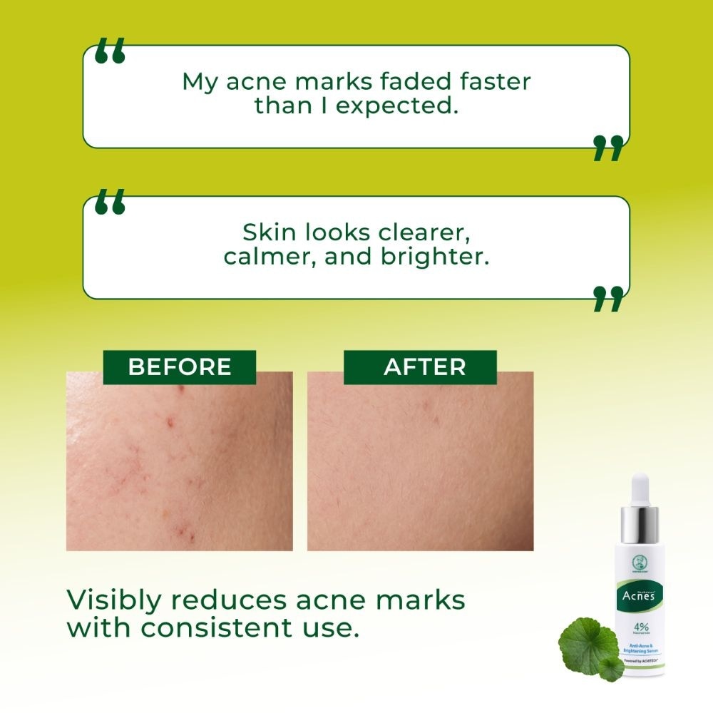 Anti-Acne & Brightening Serum 30ml