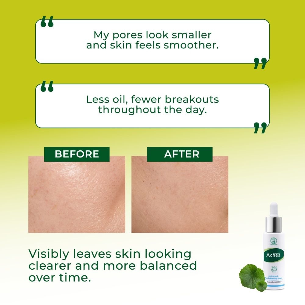 Anti-Acne & Pore Tightening Serum 30ml