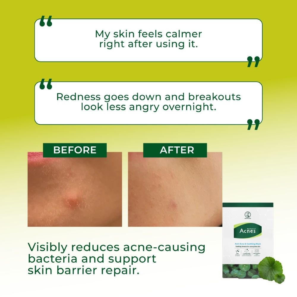 Anti-Acne & Soothing Facial Mask 5s