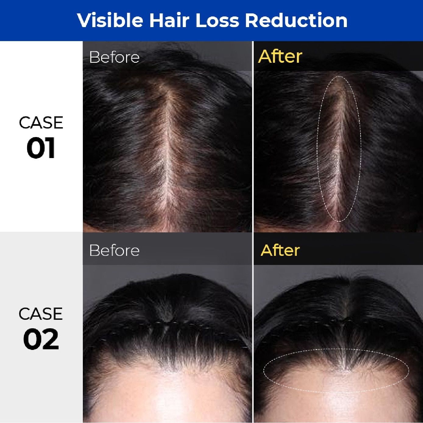 Lab Shampoo for Anti-Hair Loss 1000ml