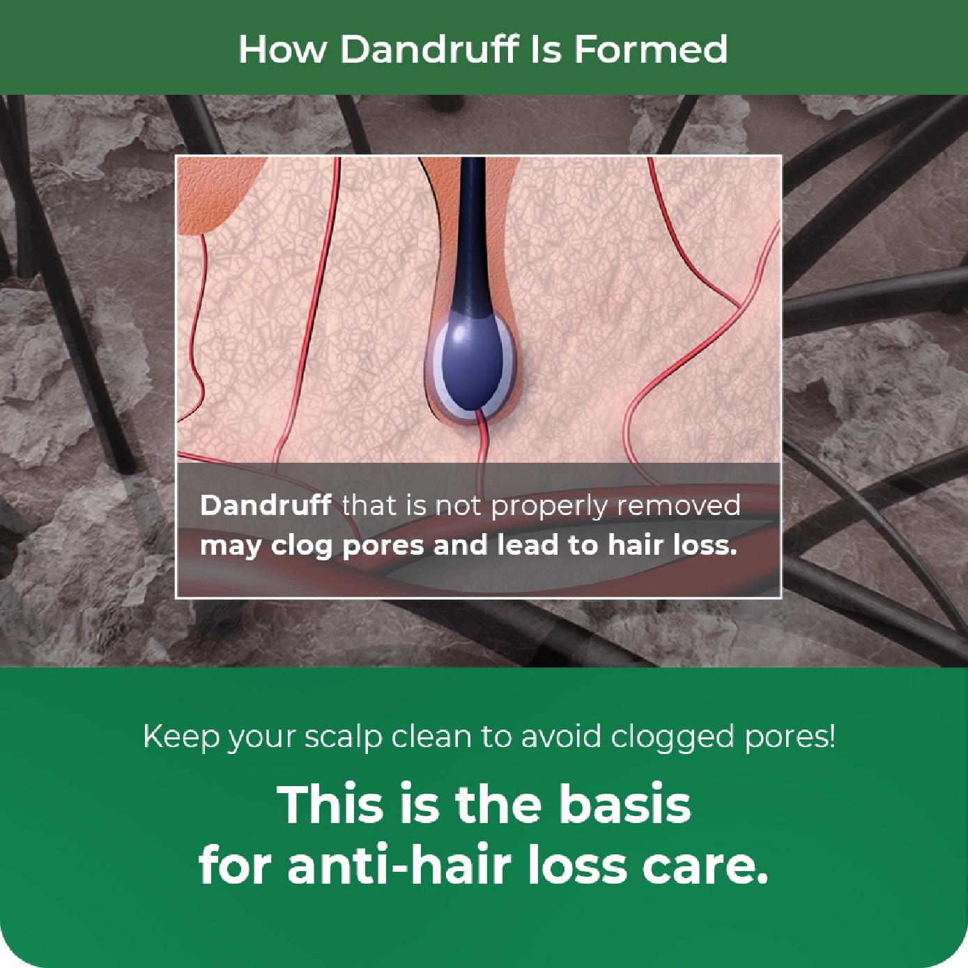 Dandruff Shampoo for Anti-Hair Loss 1000ml