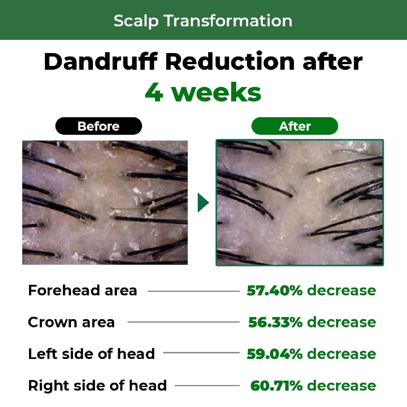 Dandruff Shampoo for Anti-Hair Loss 1000ml