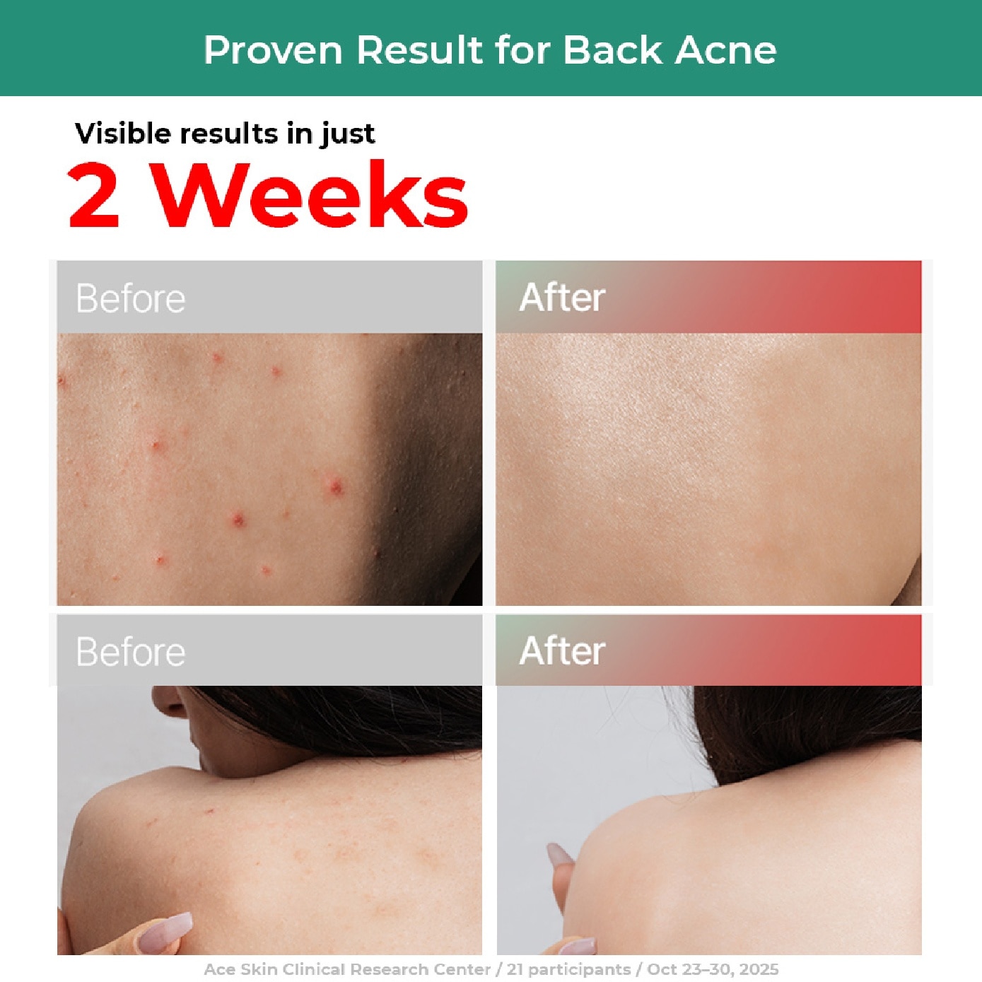 Acneform Skin Alleviating Functional Body Wash 1000ml