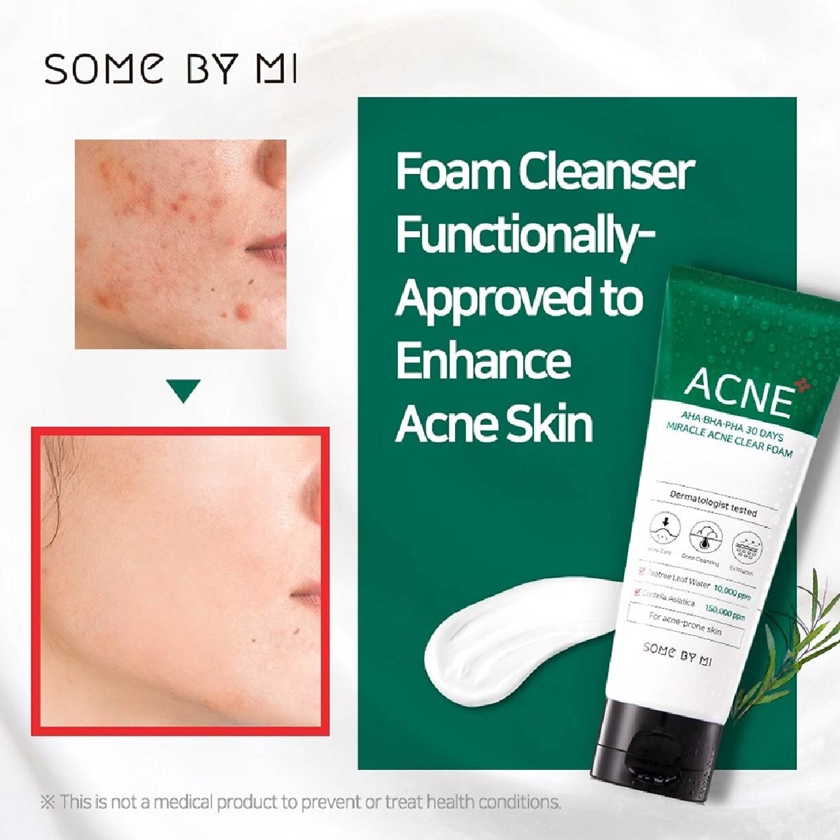 30 Days Miracle Anti-Acne Clear Foam 100ml