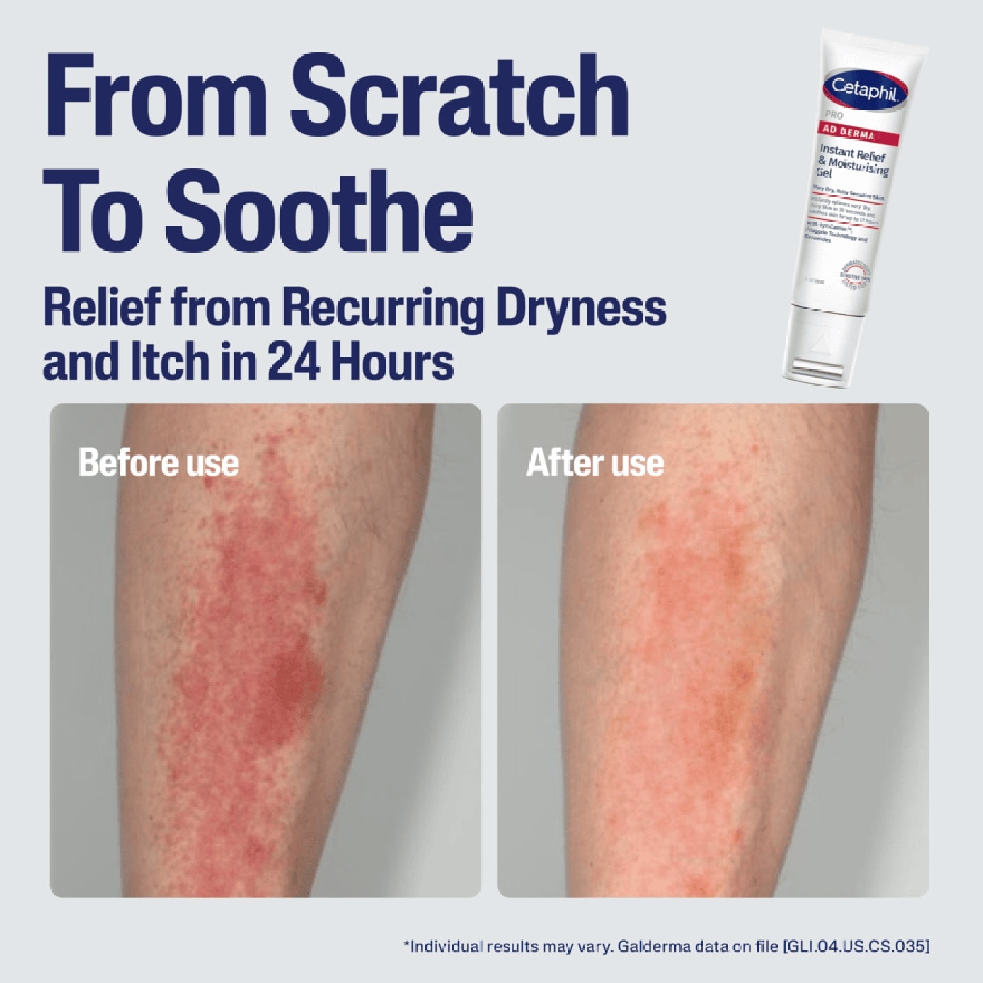 PRO AD Derma Instant Relief & Moisturising Gel 59ml