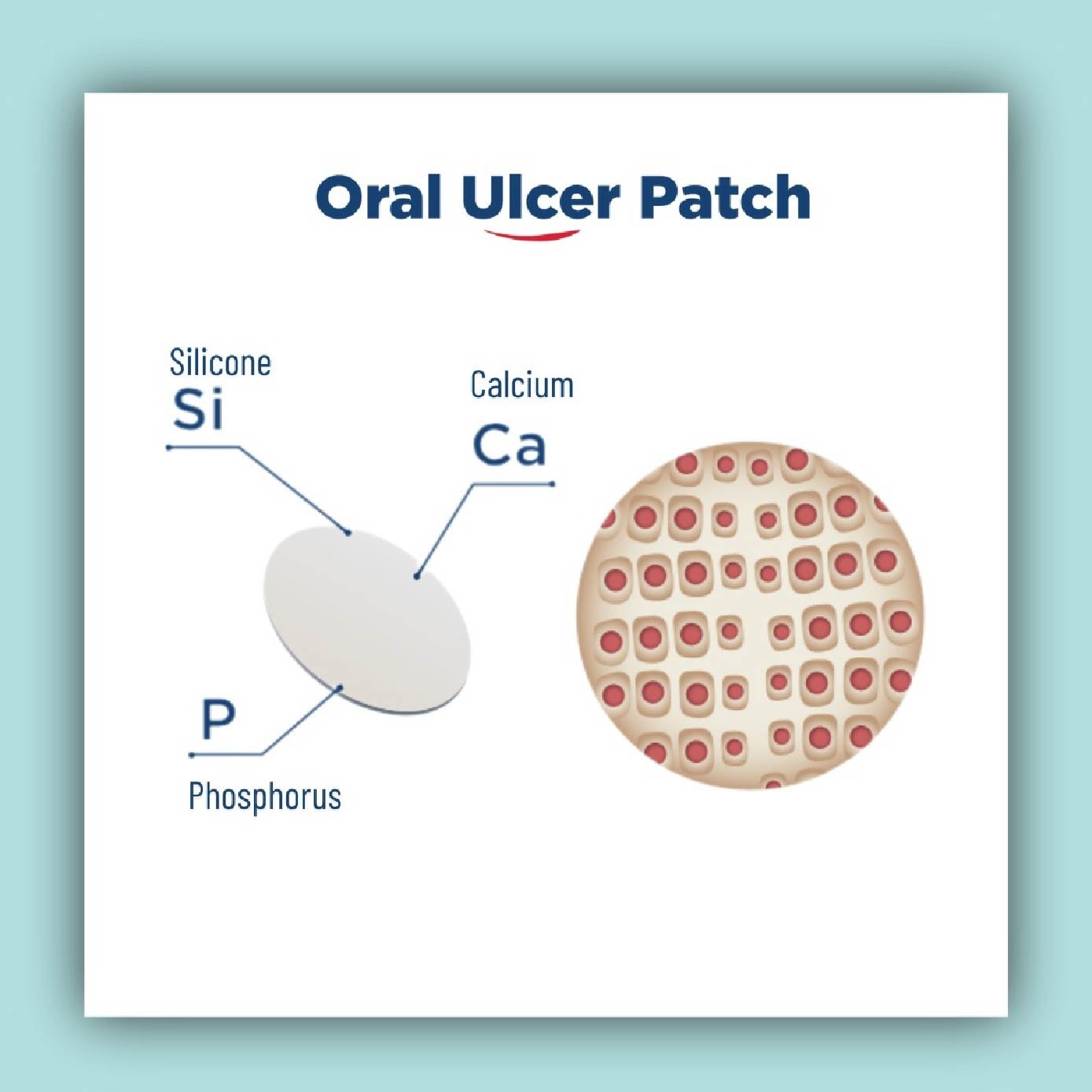 Oral Ulcer Patch (Safe For Pregnant Women & Children) 6s
