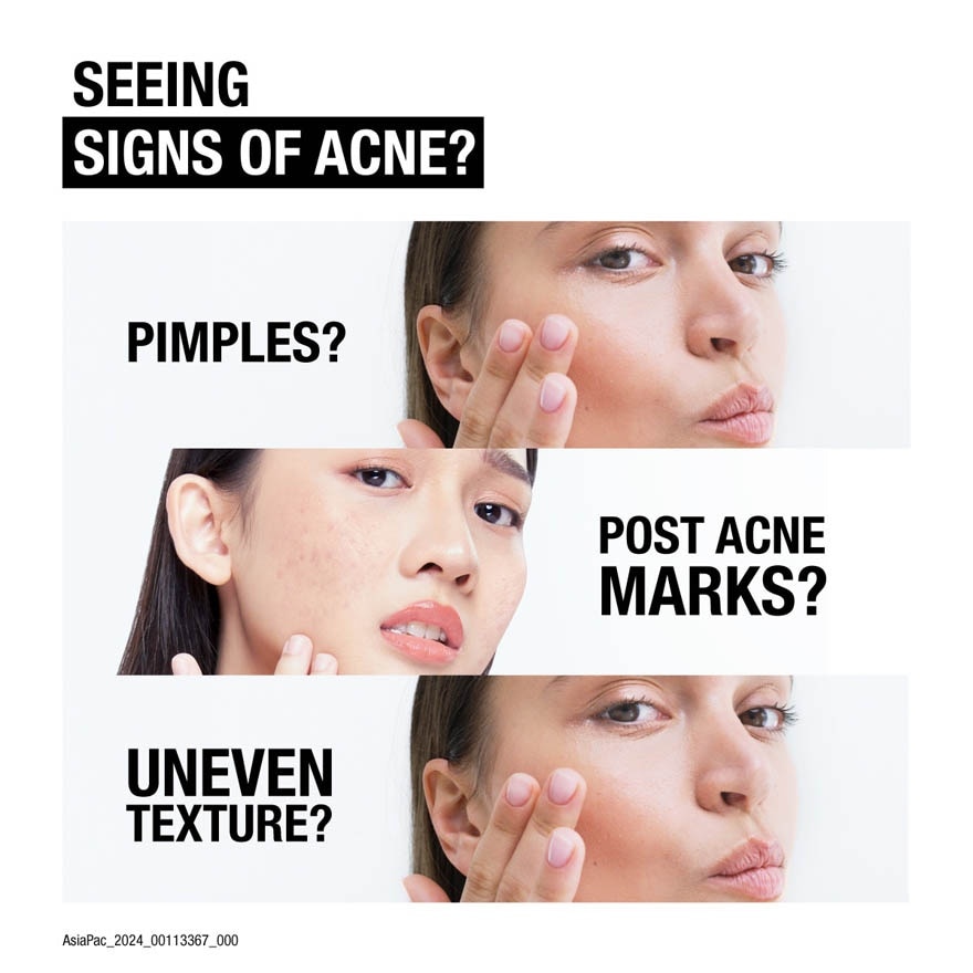 Advanced Acne Cleanser (To Helps ClearUp Spots For Acne Prone Skin) 150ml
