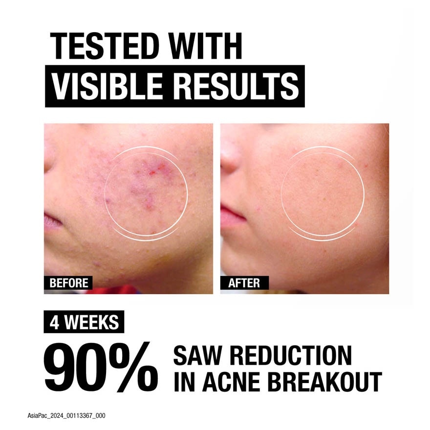 Advanced Acne Cleanser (To Helps ClearUp Spots For Acne Prone Skin) 150ml
