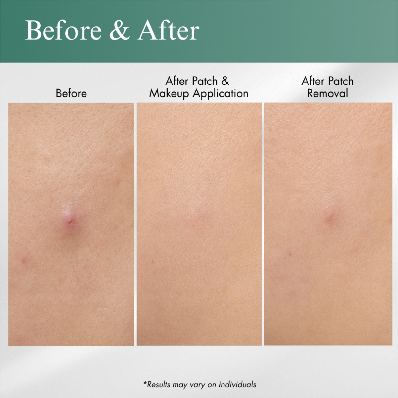 BHA Invisible Acne Patch Gel 15ml image
