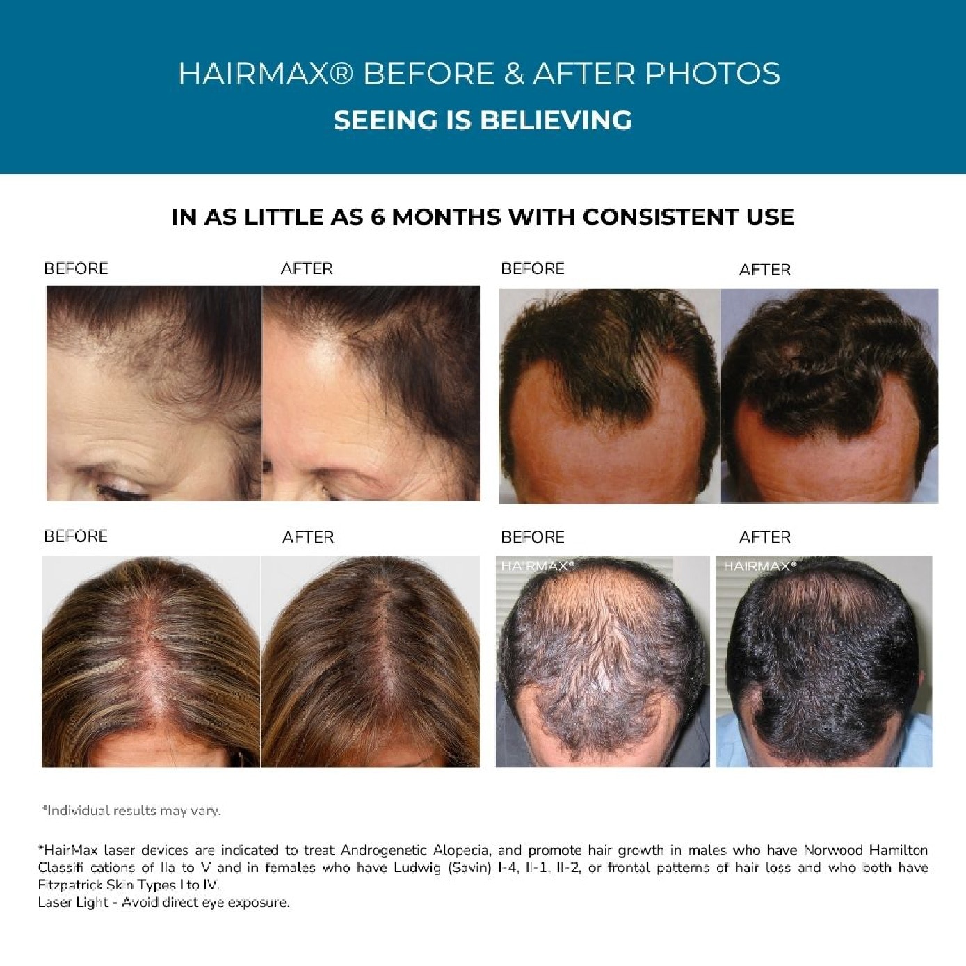 LaserBand 82 ComfortFlex Hair Growth Laser Device 1s image