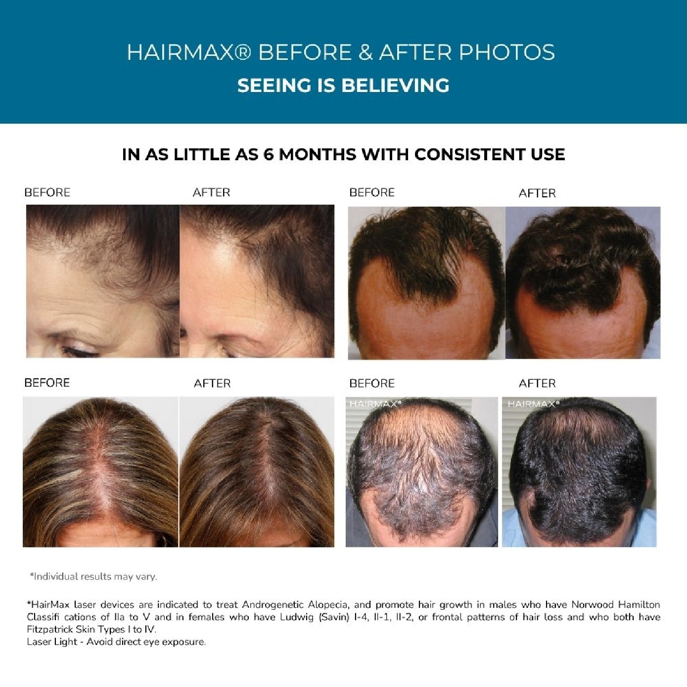 LaserBand 41 ComfortFlex Hair Growth Laser Device 1s image