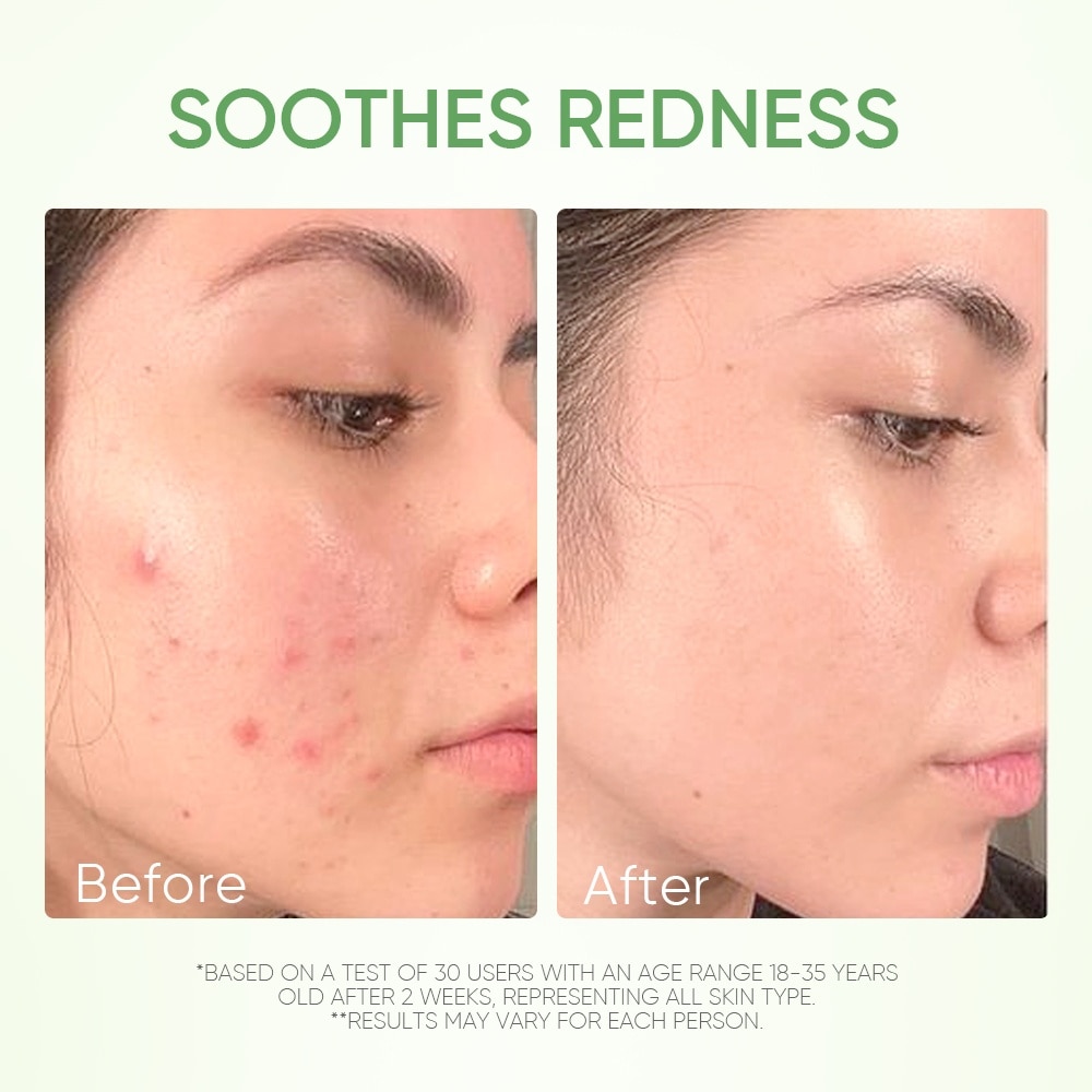 Mugwort Anti Pores & Acne Clay Mask (To Unclogs & Refines Pores, Prevents & Reduce Breakouts) 55g