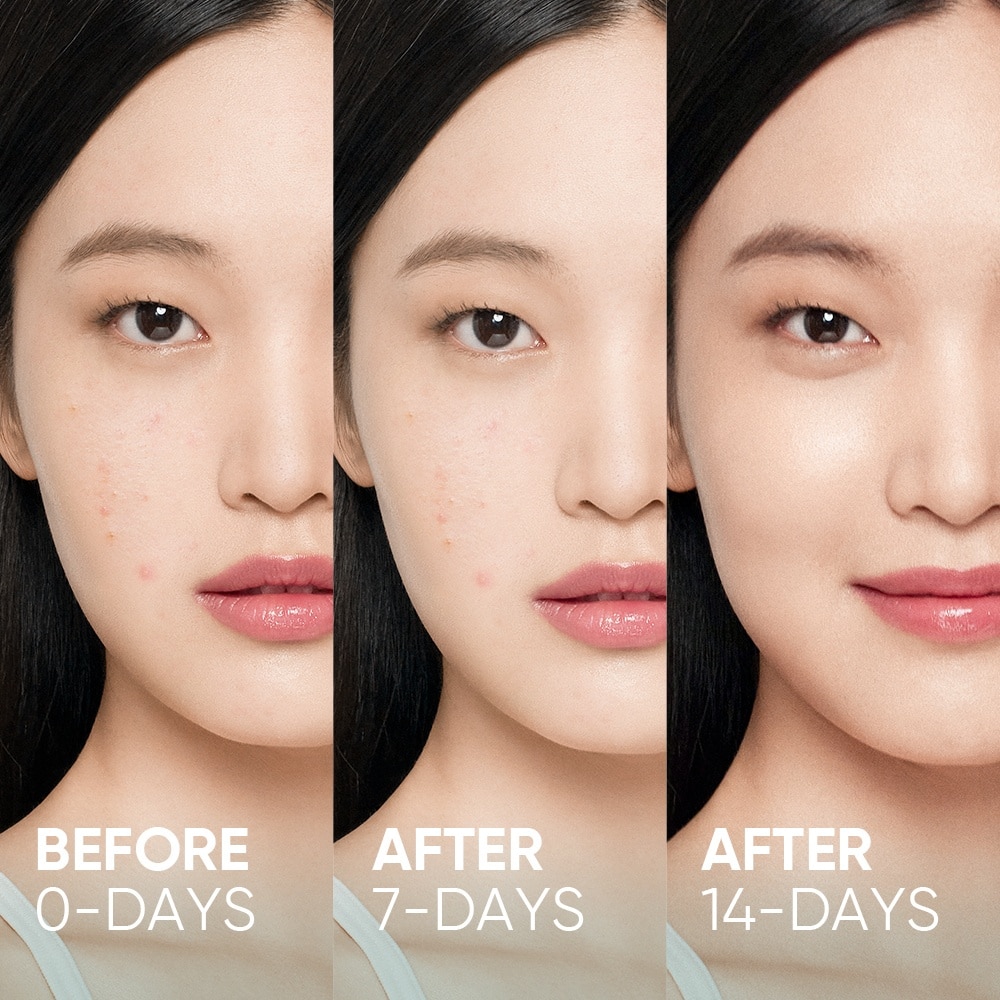 2% Salicylic Acid Anti Acne Serum (For Eliminates Acne & Bumps, Prevents Acne Scars, Reduces Redness & Dark Spots) 20ml