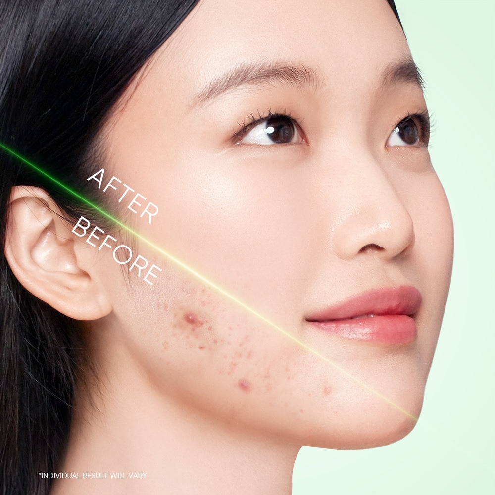 3X Acid Acne Gel Cleanser (To Cleans Pores & Excess Sebums, Hydrates Skin & Refreshes) 120ml