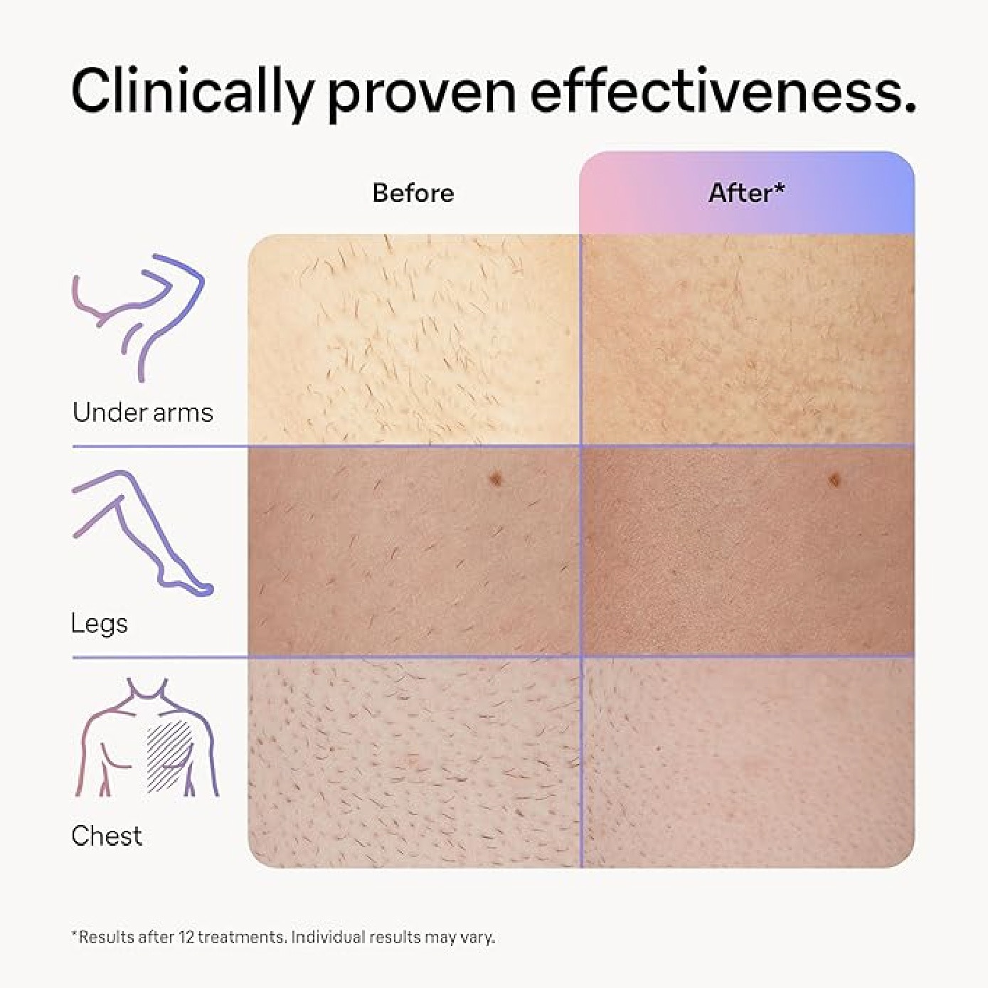 Skin i-Expert PL 7253 IPL Device 1s