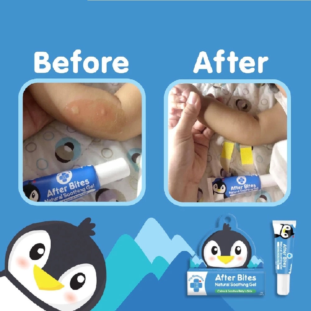 After Bites – Natural Soothing Gel for Babies & Kids 20g