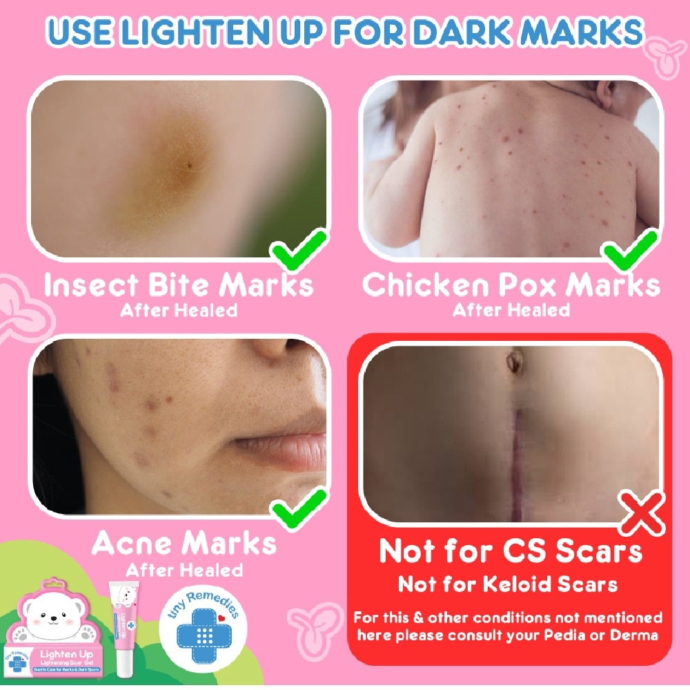 Lighten Up – Natural Lightening Scar Gel for Babies & Kids 20g
