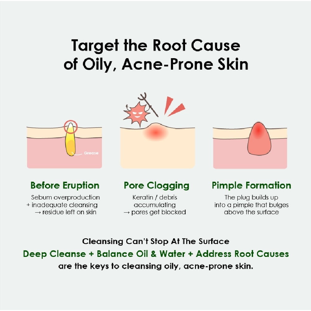 Acne Free Cleansing Foam 80g